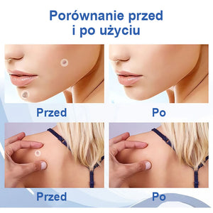 Plastry na brodawki i znamiona (kup 1, a 1 dostaniesz gratis)